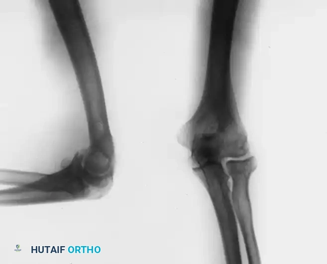 LOOSE BODIES Surgical Diagram