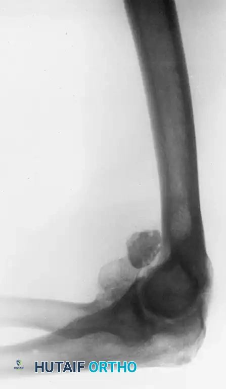 Elbow Arthroscopy: Loose Bodies & Osteochondritis Dissecans