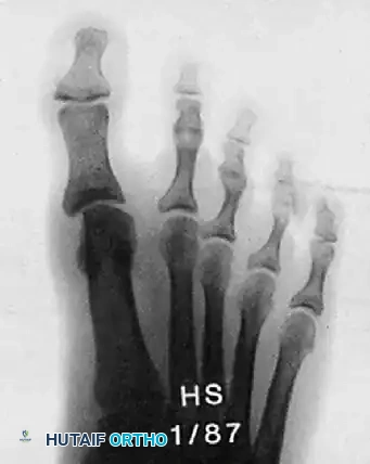 Illustration of hallux valgus angle - Dr. Mohammed Hutaif