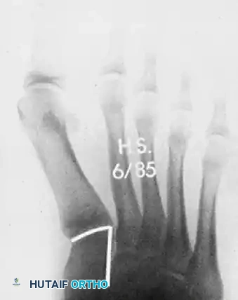 صورة شعاعية بعد ثمانية عشر شهرا من المتابعة توضح تصحيح الزاوية مع بعض التغيرات في المفصل