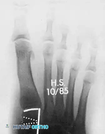 صورة شعاعية بعد الجراحة توضح استخدام تقنية الشق العظمي المفتوح وتصحيح الأنسجة الرخوة