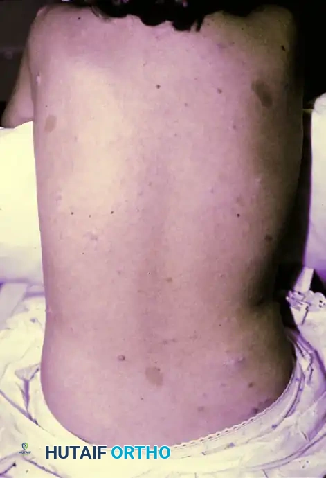 Comprehensive Surgical Management of Benign Hand Tumors: Soft Tissue and Osseous Lesions