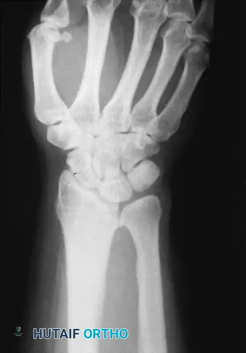 الدليل الشامل لفهم وعلاج تشوه مادلونغ في الرسغ