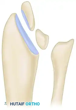تخطيط جراحي يوضح أماكن قطع العظم في الكعبرة