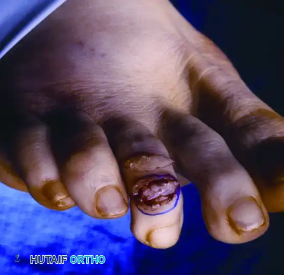 MALLET TOE Surgical Diagram