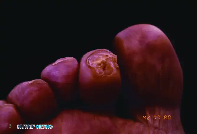 MALLET TOE Surgical Diagram