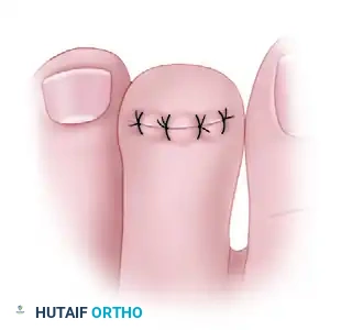 MALLET TOE Surgical Diagram