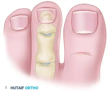 MALLET TOE Surgical Diagram