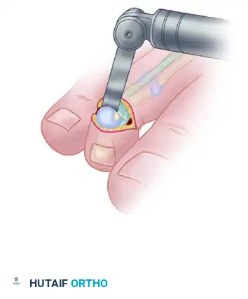MALLET TOE Surgical Diagram