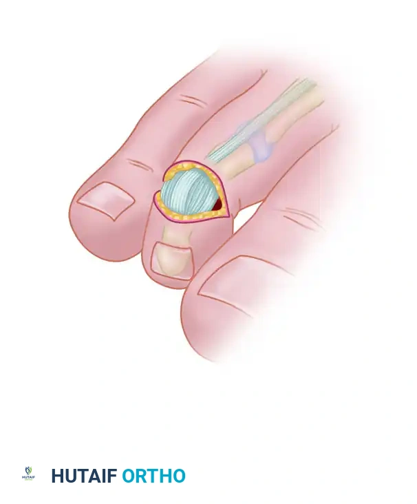 MALLET TOE Surgical Diagram