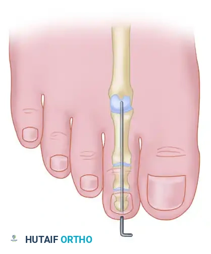 MALLET TOE Surgical Diagram