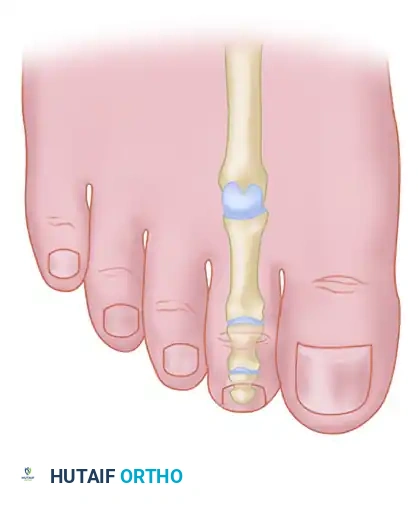 MALLET TOE Surgical Diagram