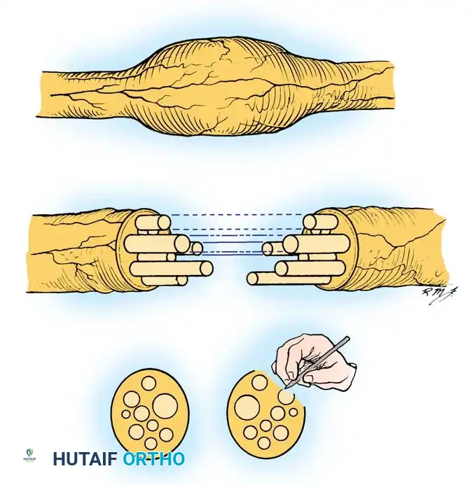 Step-cut technique of Millesi