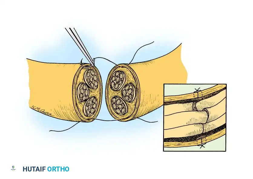 Basic suture technique for peripheral nerves