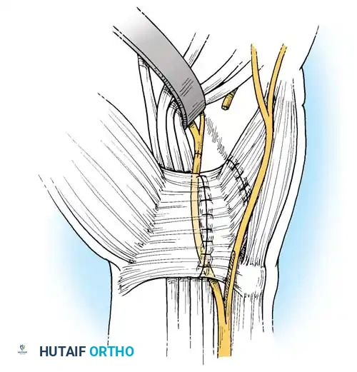 Boyes technique - Exposure