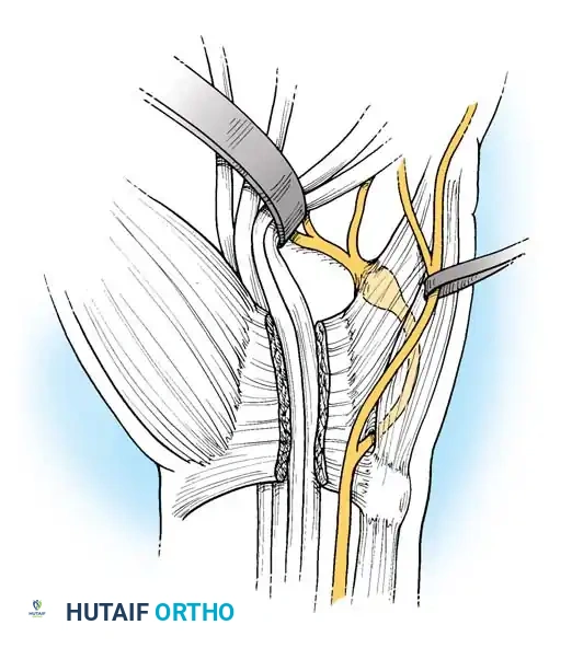 Boyes technique - Intraneural splitting