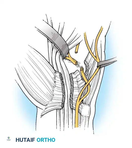 Boyes technique - Freshening ends
