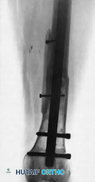 MASSIVE SLIDING GRAFT Surgical Diagram