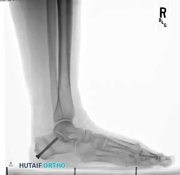 Clinical Presentation of Flexible Pes Planus