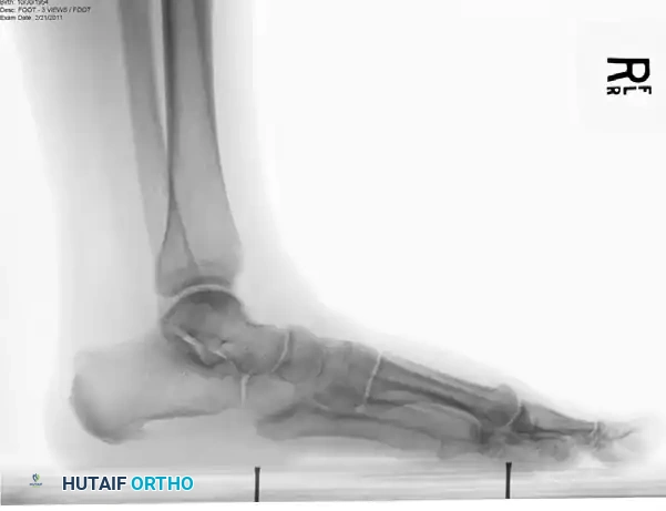 Preoperative AP/Oblique Radiograph