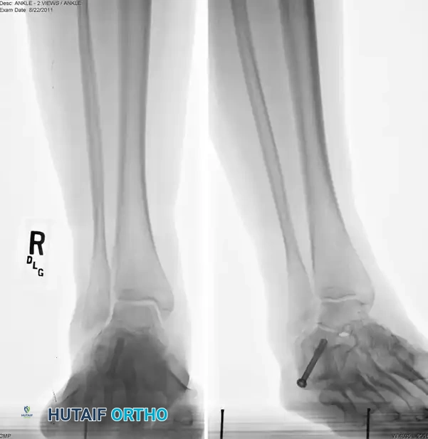 Postoperative Axial Radiograph Demonstrating Medial Shift and Screw Placement