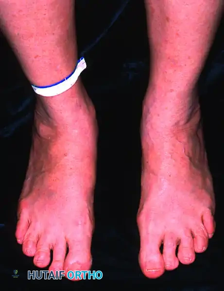 Hindfoot Valgus Deformity - Posterior View