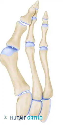 موقع القطع العظمي بعد المباعدة ووضع الطعم العظمي لتثبيت التصحيح