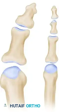 قياس الزاوية المفصلية للسلامية لتقييم شدة انحراف إصبع القدم الكبير قبل الجراحة