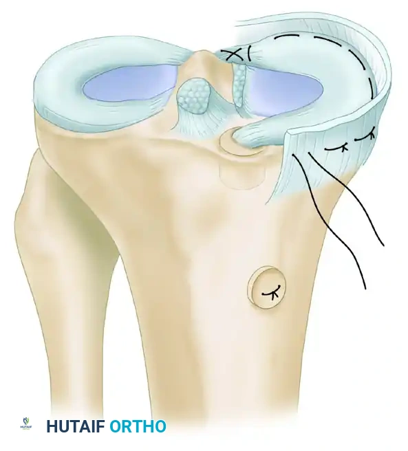 Graft Insertion Initiation