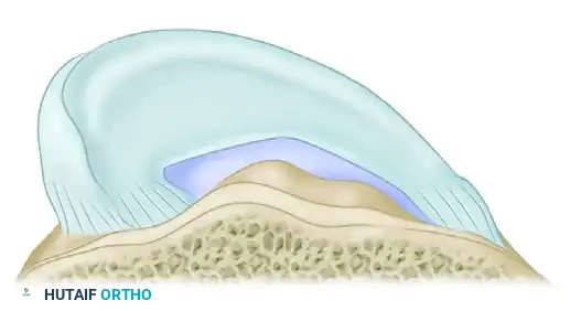 Meniscal Allograft Transplantation: The Double Bone Plug Technique