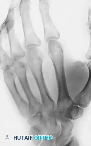 Metacarpal Head Fractures: Comprehensive Surgical Management