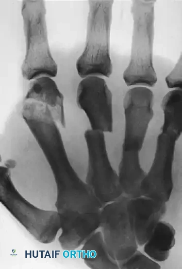 METACARPAL HEAD FRACTURES Surgical Diagram