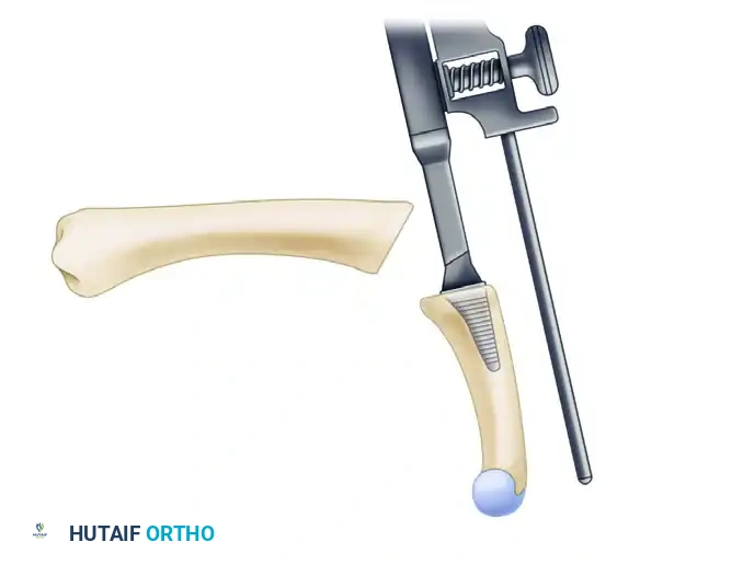 Metacarpal Joint Surface Arthroplasty: A Comprehensive Surgical Guide