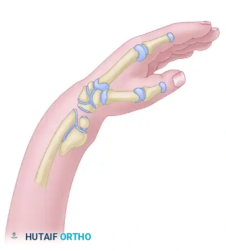 Comprehensive Management of Congenital Hand Anomalies: Metacarpal Lengthening and Radial Dysplasia