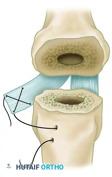 Metacarpophalangeal Joint Arthroplasty: Swanson Technique