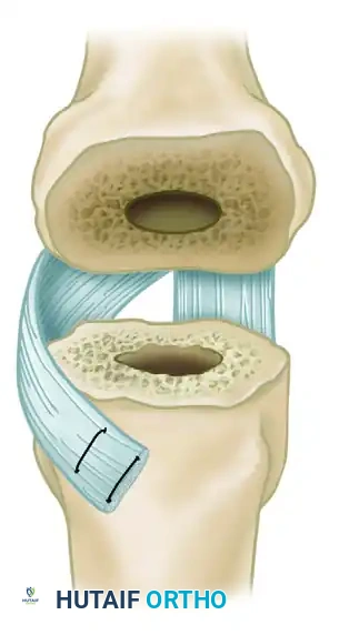 FIGURE 73-25 Swanson technique for reconstruction of radial collateral ligament of index metacarpophalangeal joint by using slip of volar plate. SEE TECHNIQUE 73-10.