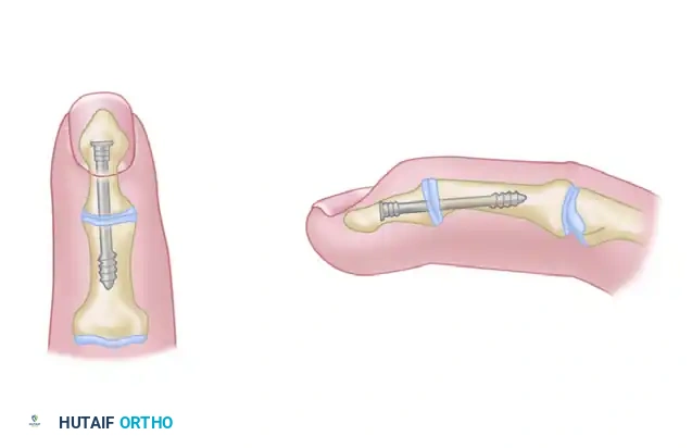 METACARPOPHALANGEAL JOINT ARTHRODESIS Surgical Diagram