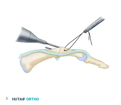 METACARPOPHALANGEAL JOINT ARTHRODESIS Surgical Diagram