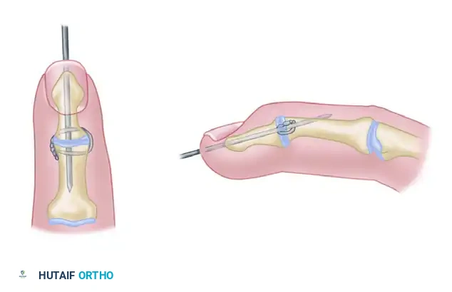 METACARPOPHALANGEAL JOINT ARTHRODESIS Surgical Diagram