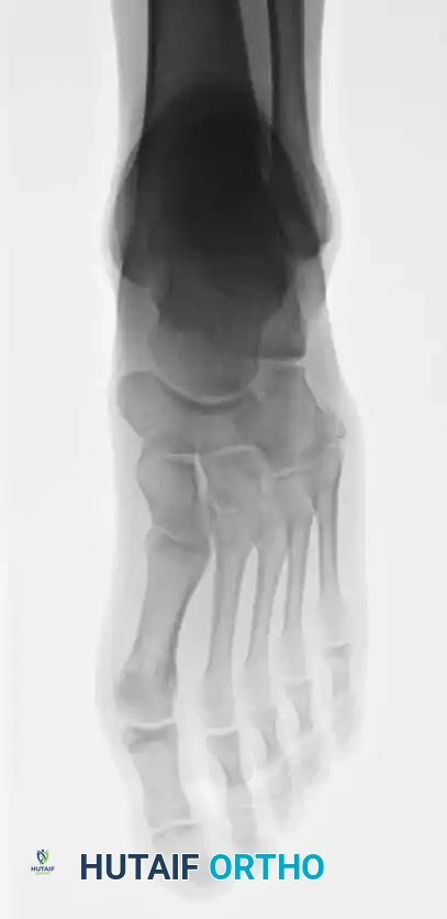Fig. 86-44 A-C, Type IIIB (DeLee) ﬁ fth metatarsal fracture.