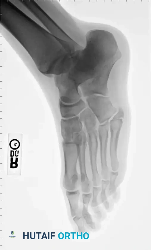 Fig. 86-44 A-C, Type IIIB (DeLee) ﬁ fth metatarsal fracture.