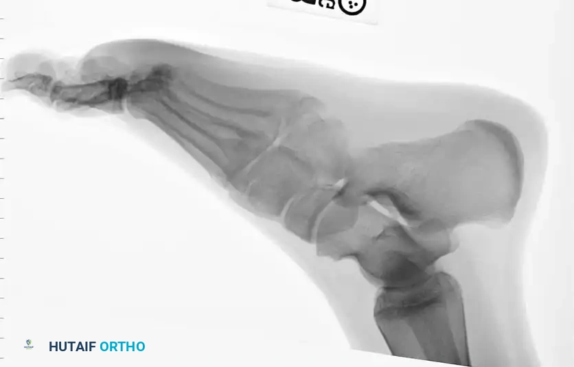 Fig. 86-44 A-C, Type IIIB (DeLee) ﬁ fth metatarsal fracture.
