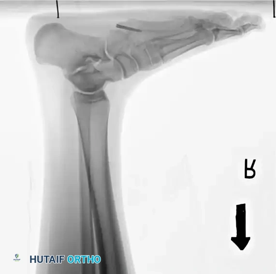 Fig. 86-44, cont’d D-F, After screw ﬁ xation.