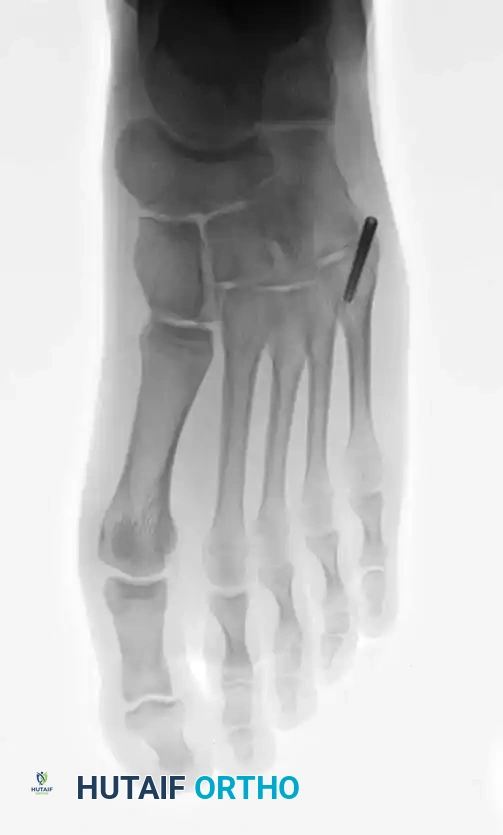 Fig. 86-44, cont’d D-F, After screw ﬁ xation.