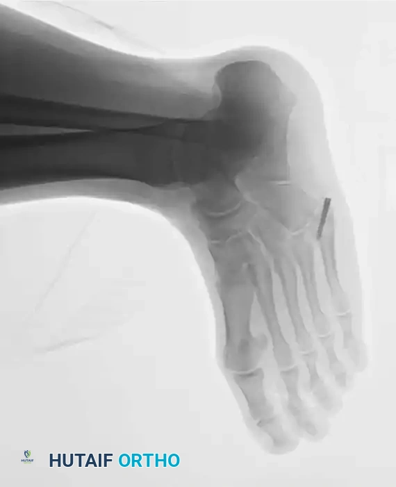 Fig. 86-44, cont’d D-F, After screw ﬁ xation.