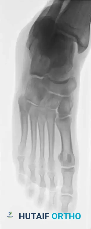 Fig. 86-45 A-C, Type IA (DeLee) ﬁ fth metatarsal fracture in collegiate soccer player. D-F, After ﬁ xation with variable pitch compression screw.