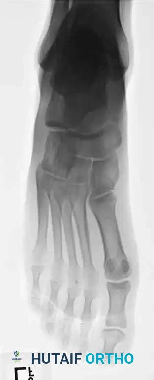 Fig. 86-45 A-C, Type IA (DeLee) ﬁ fth metatarsal fracture in collegiate soccer player. D-F, After ﬁ xation with variable pitch compression screw.