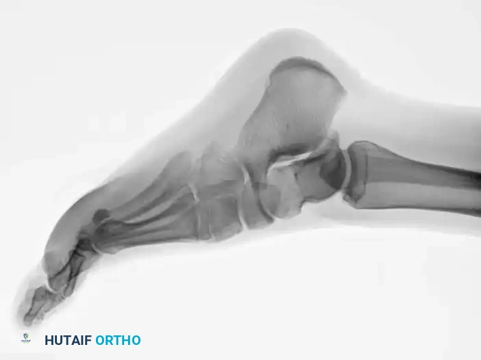 Fig. 86-45 A-C, Type IA (DeLee) ﬁ fth metatarsal fracture in collegiate soccer player. D-F, After ﬁ xation with variable pitch compression screw.