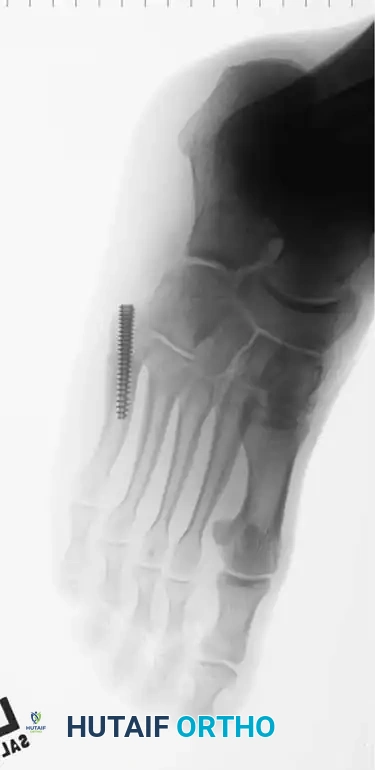 Fig. 86-45 A-C, Type IA (DeLee) ﬁ fth metatarsal fracture in collegiate soccer player. D-F, After ﬁ xation with variable pitch compression screw.
