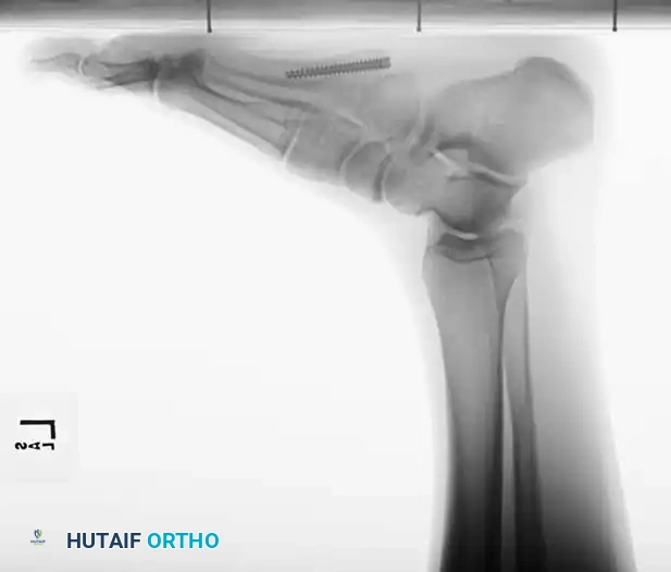 METATARSALS Surgical Diagram